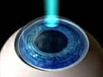 lasik-step-2