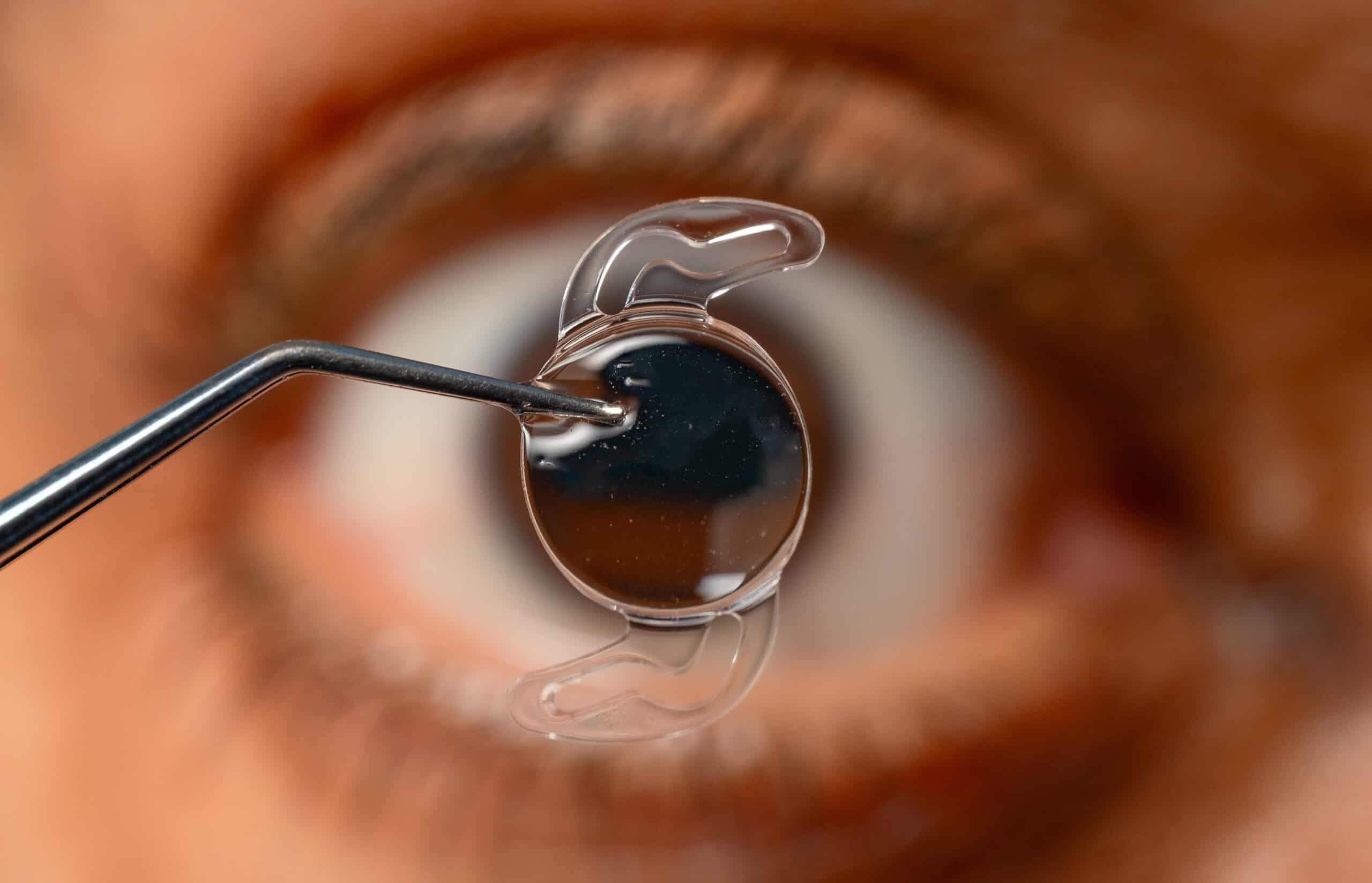 Foldable TECNIS Symfony IOL positioned for cataract surgery.