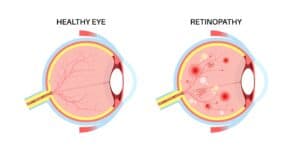 Side by side illustration compares a healthy eye to one with diabetic retinopathy.