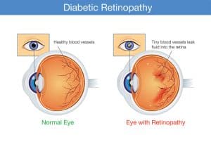 Diabetic Retinopathy Solutions In Scottsdale, Glendale, Phoenix & Mesa, AZ